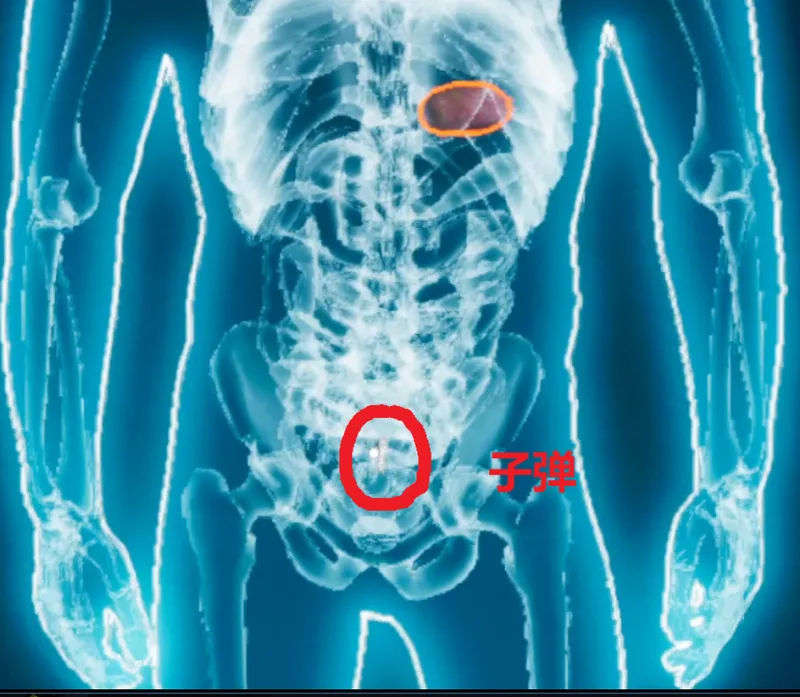 《检疫区：最后一站》皮下之物成就攻略