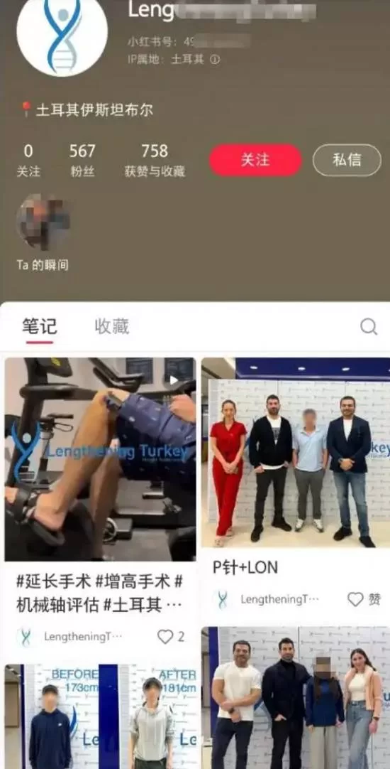 断骨增高术”风险揭秘-专家详解手术过程与国内现状